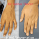 Hand rejuvenation surgery in Mumbai