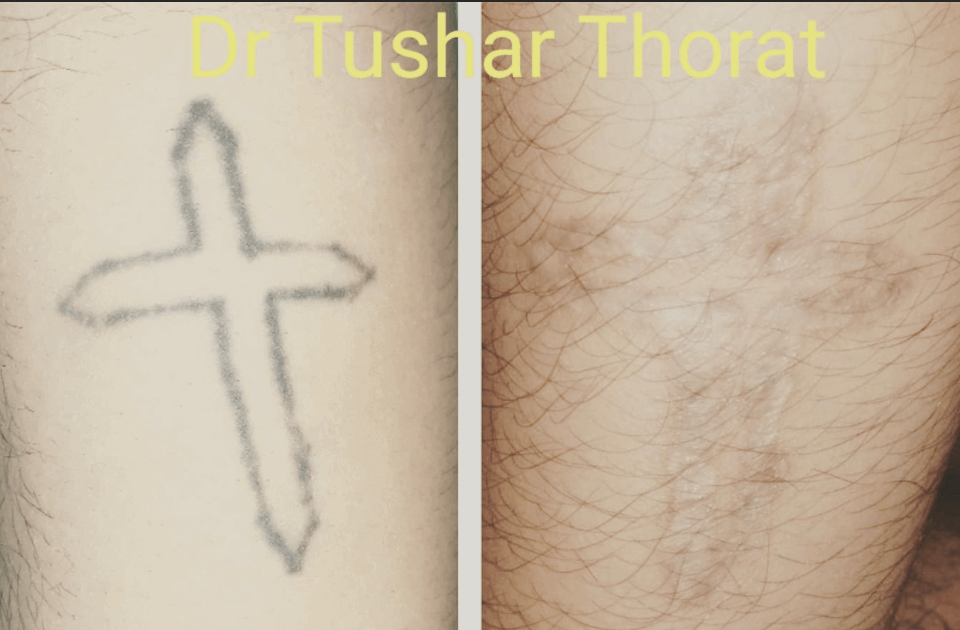 Tattoo Removal Surgery in Mumbai