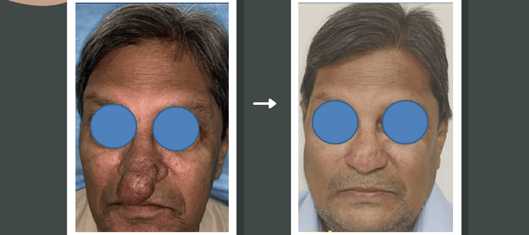 Nose Job Surgery in Mumbai